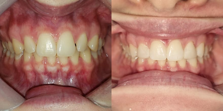 Antes e depois de um cliente que realizou tratamento com a SouSmile