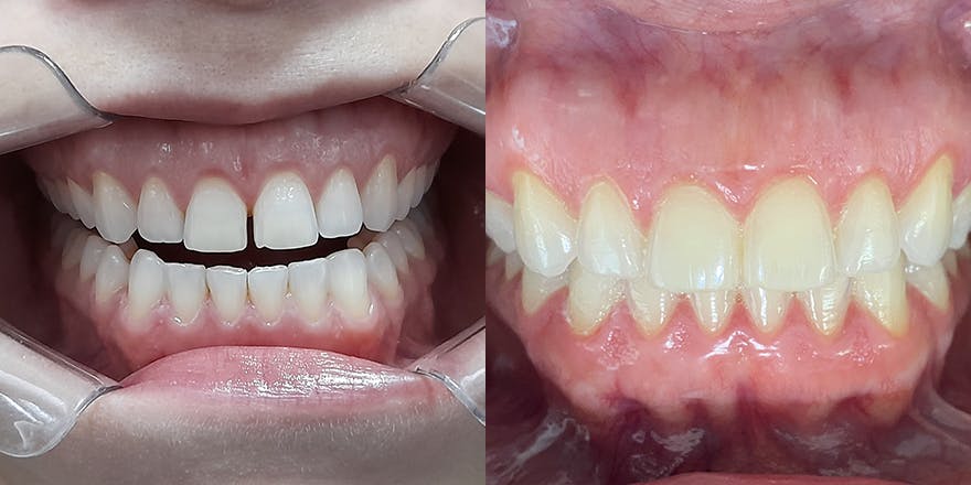 Antes e depois de um cliente que realizou tratamento com a SouSmile