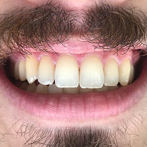 Dentes de cliente SouSmile após o uso do aparelho invisível