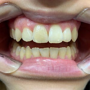 Dentes de cliente SouSmile após o uso do aparelho invisível