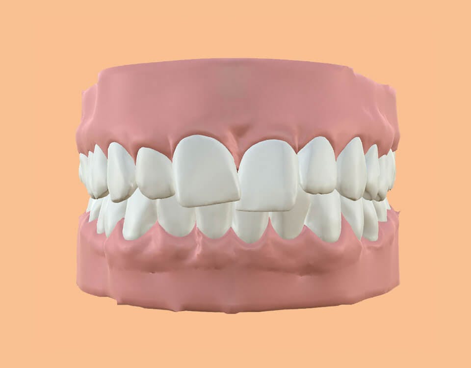 Dentes tortos