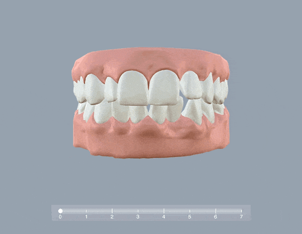 Planejamento 3D das movimentações dos dentes com o tratamento de aparelho transparente