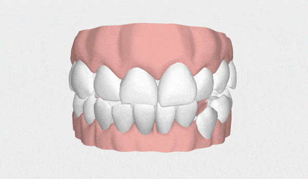 Posso usar alinhador invisível? Veja os casos que são resolvidos com ele