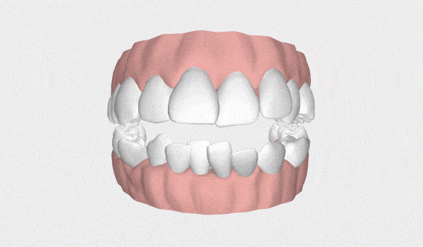 Posso usar alinhador invisível? Veja os casos que são resolvidos com ele