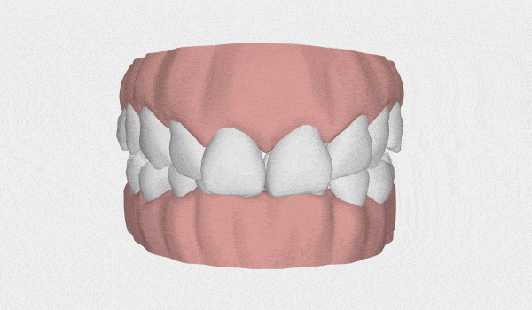 Posso usar alinhador invisível? Veja os casos que são resolvidos com ele