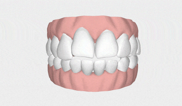 Posso usar alinhador invisível? Veja os casos que são resolvidos com ele