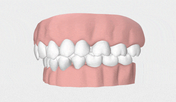 Posso usar alinhador invisível? Veja os casos que são resolvidos com ele