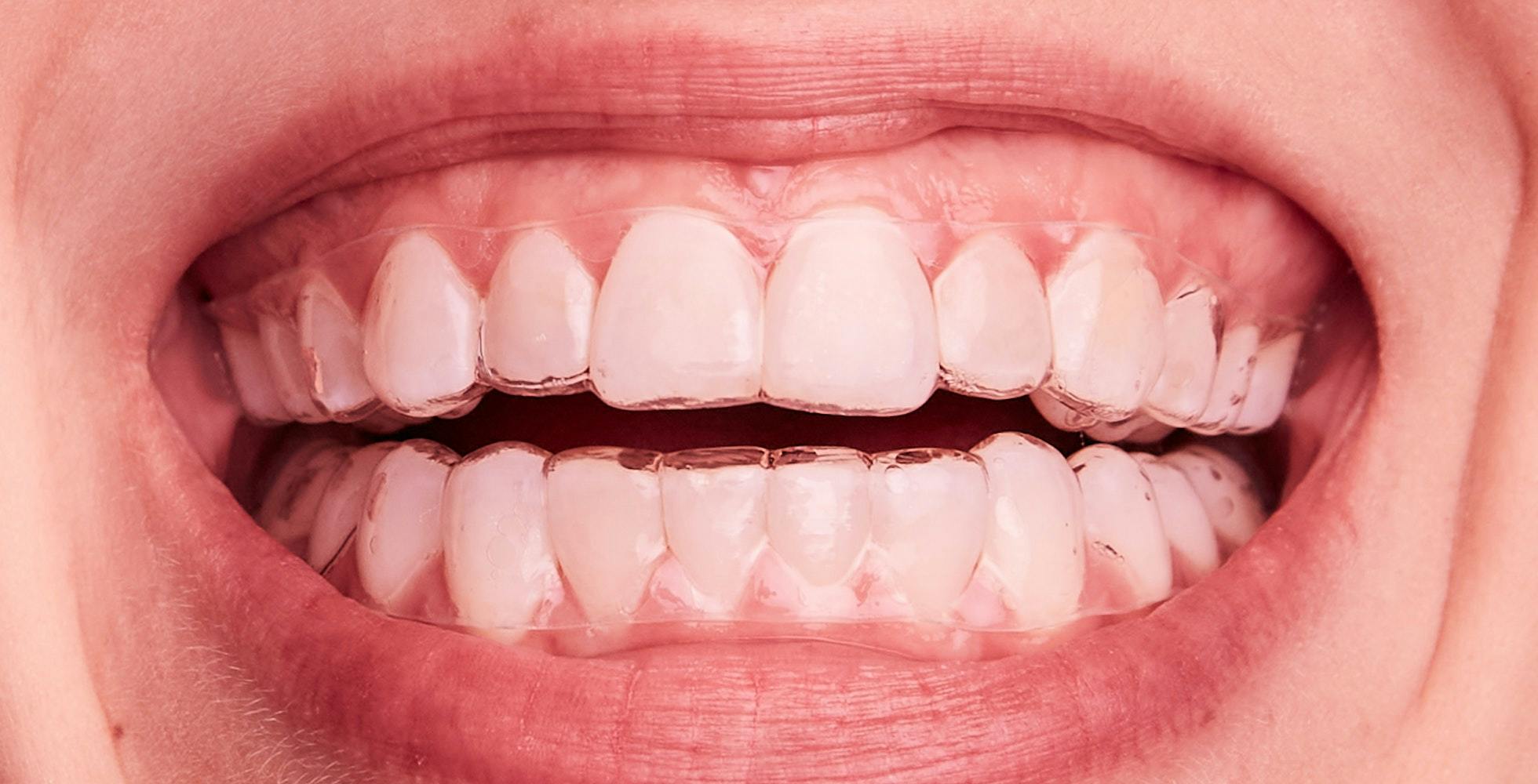 clareamento dental associação de técnicas sousmile