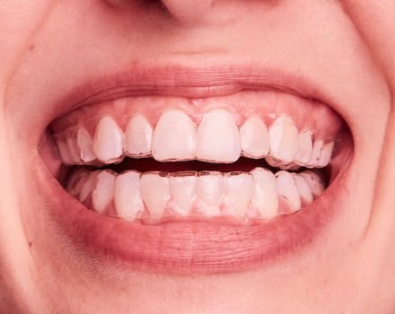 clareamento dental associação de técnicas sousmile