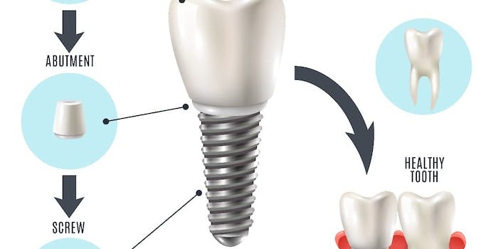 implante-dentario-estrutura