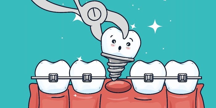 dente-implante
