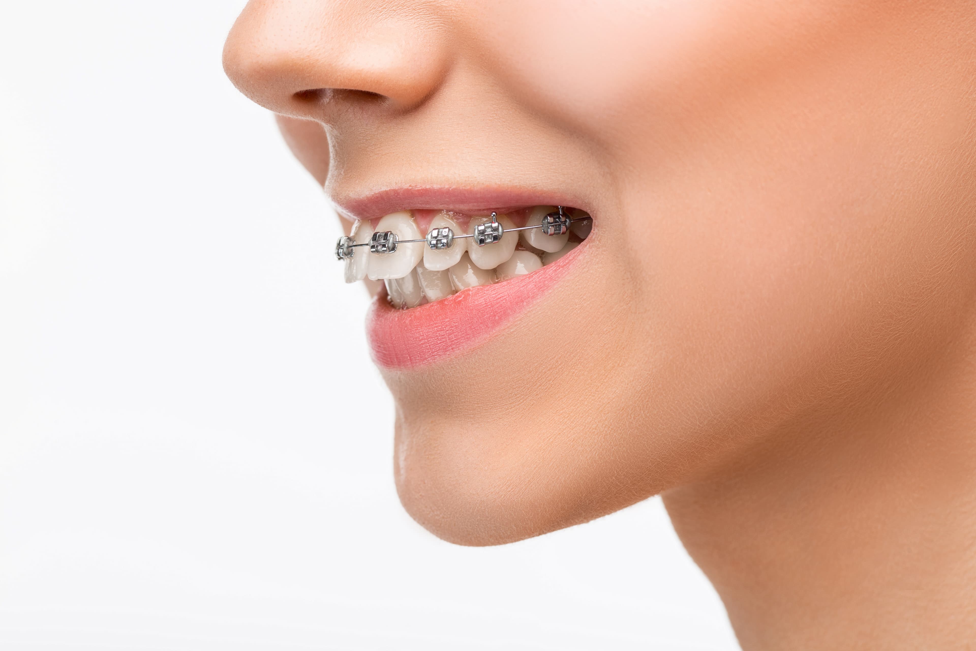 Preço para tirar o aparelho fixo dos dentes veja quanto custa SouSmile Preço para tirar o aparelho fixo dos dentes veja quanto custa SouSmile